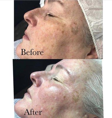 Client came in with concerns of hyperpigmentation. We did a deep manual exfoliation and oxygen facial to get these results.