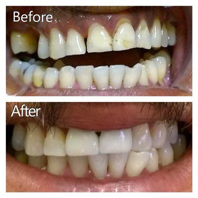 BEFORE and AFTER take on a patient! Crowns beautifully done, HOLLYWOOD SMILE! #8 and #9