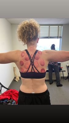 We provide therapeutic cupping