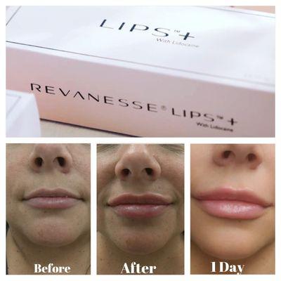 Try our New Lip filler product by Versa Revanesse. Amazing Results!!!!  Come in for a free consultation.