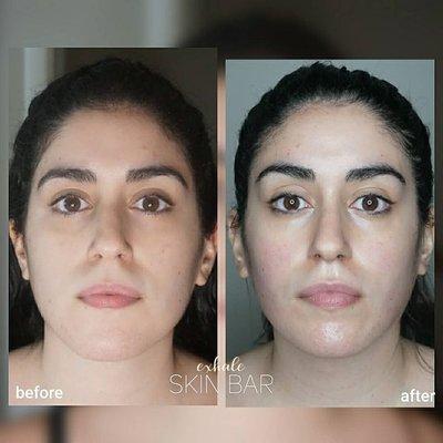 Sculptural Face Lifting w. Lymphatic Drainage & Gua Sha Results