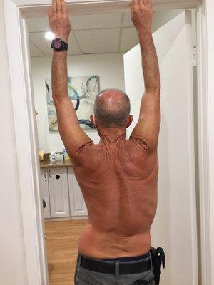 My back misalignment BEFORE working with Dr. Simone Salles