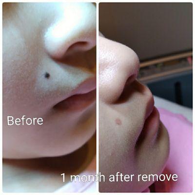 10 years old girl mole remove before and after 
10 year girl mole remove