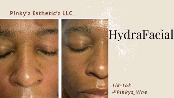 Looking for 3 models to get hydra-facial!!! :)very discounted pricing! Book Now!