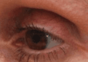 Example of hollow upper eyelid from excess fat removal and crease made too high.