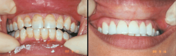 Porcelain Laminates to correct stained teeth.