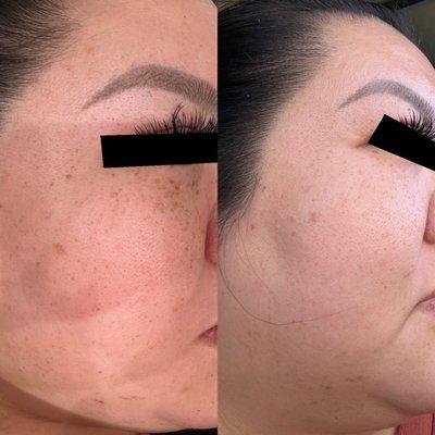 Hyperpigmentation Removal with  Cool View Laser after 1x Treatment (Right side of Face)