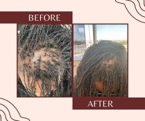 Hair Restoration- 3 sessions