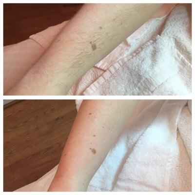 Before (top) + After (bottom) of sugar hair removal.