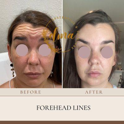 Smooth out forehead lines with Botox treatment