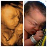 3D Ultrasound photo taken at GoldenView Ultrasound before and after birth compairson photo