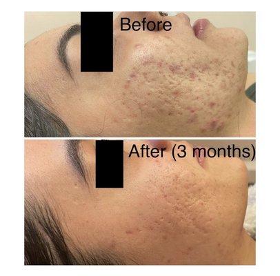 Inflamed acne Before and After