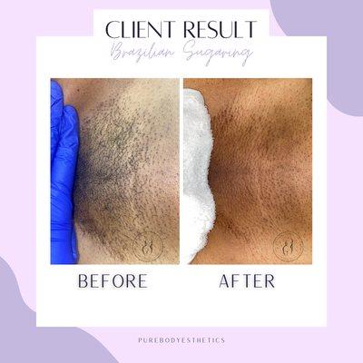 Brazilian Sugaring: Before & After!