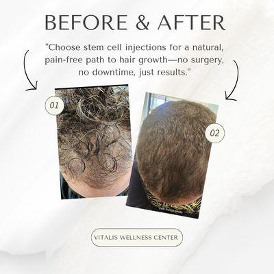 Before and after of PRP Scalp Injections after the 3rd session.