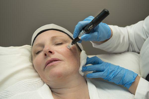 Microneedling experts at Focal Point with Growth Factors