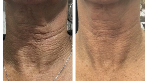 Nefertiti Neck Lift