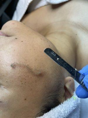 Dermaplaning facial to reach an smooth and bright skin removing dead cells y getting better results from your skincare