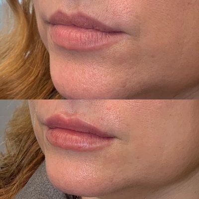 Juvederm ultra lip filler