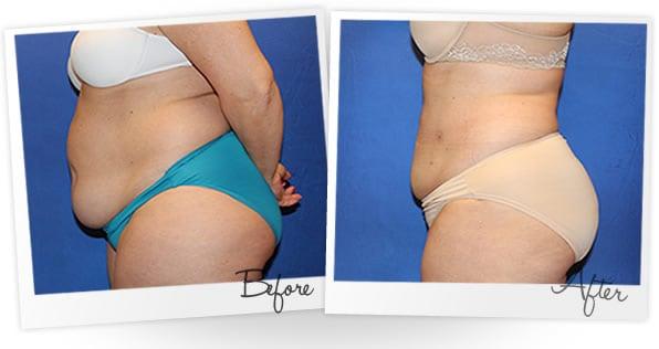 SMARTLipo Before & After