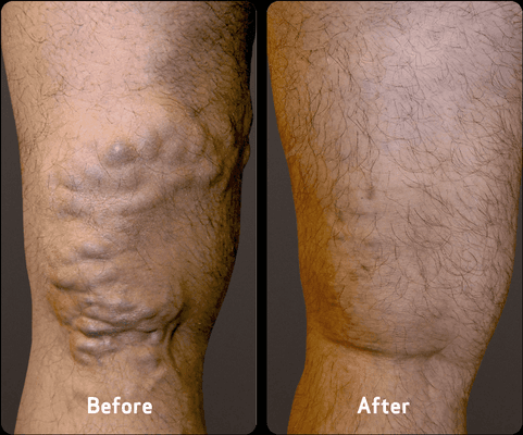 USA Vein Clinics Before and After Treatment