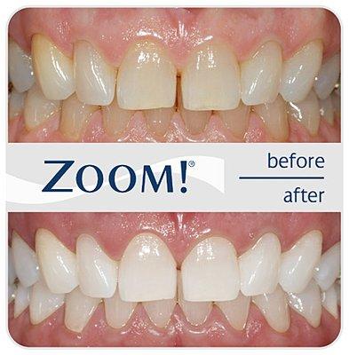 We offer Zoom! Teeth Whitening, which is a professional whitening service that can bring your teeth up to 6 shades lighter in just two hours