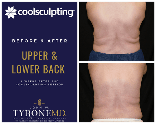 Before and after CoolSculpting to the lower and upper back