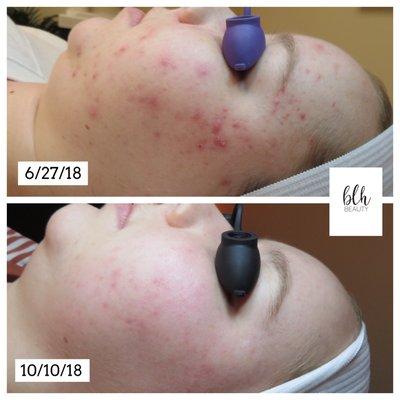 Inflamed Acne, with homecare and coming every two weeks for treatment.