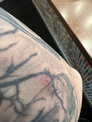 Bed bug bites