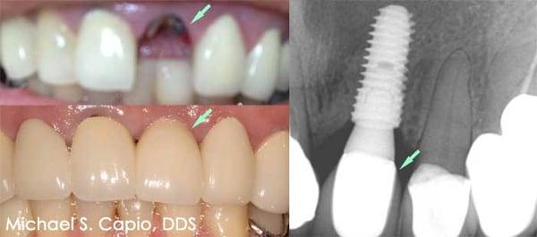 This broken front tooth could not be saved.  A dental implant was placed to restore proper function.