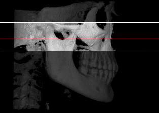 3-D Cone Beam CT