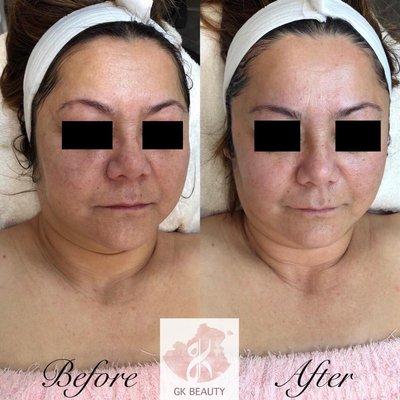 Derma-planing facial with great combination of pomegranate enzyme & charcoal mask for aging, oily skin with irregular pigmentation!