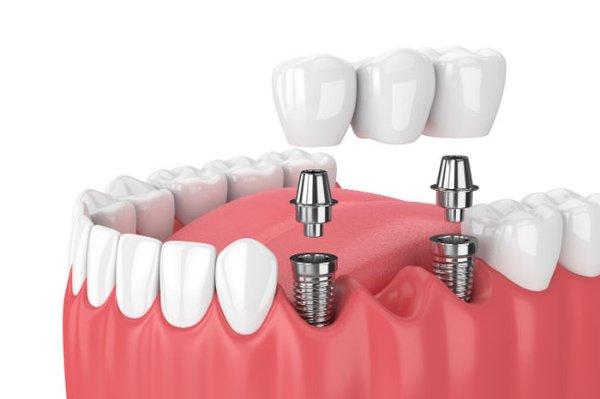 Dr. Charette offers dental implant therapies.