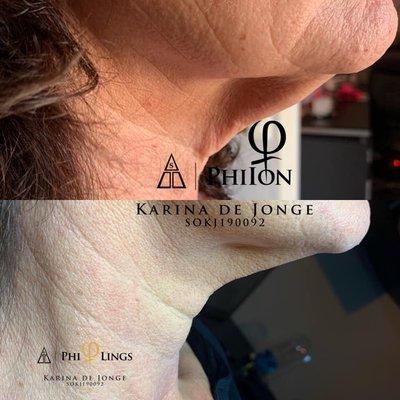 Neck lift with 2 Microneedling and 2 plasma ion