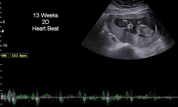 13 Weeks Heart Beat