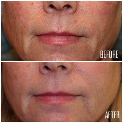 After just 2 IPL (Intense Pulse Light) sessions, our patient couldn't be happier with the results! Treatment by Heather Dahl, LMA.