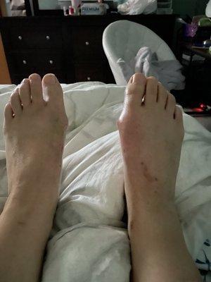 This is after surgery, healed. Both feet still have a bunion and an infection on the right.