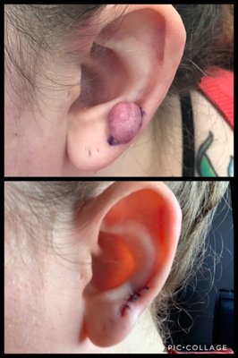 Keloid that I had removed by Dr. Schmidt