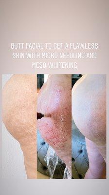 Butt Faisal to get a flawless shin with microneedling and Meso whitening