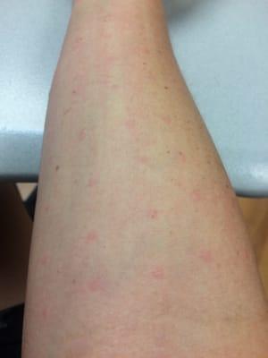 Allergy test!