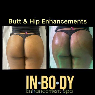 Butt Enhancement