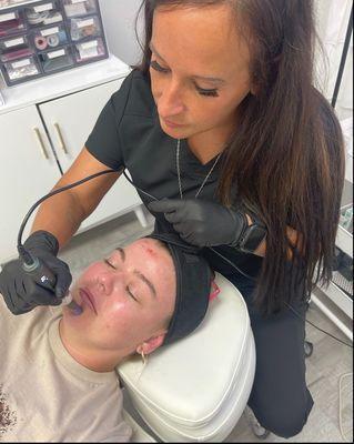 Microneedling to treat large pores, fine lines and wrinkles,  facial acne scars, stretch marks, hyerpigmentation, uneven skin tone