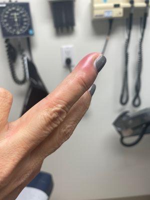 Infection in nail requires treatment with antibiotics and drainage