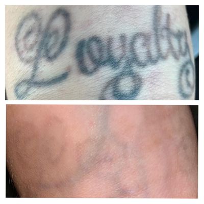 New beginnings Laser Tattoo Removal