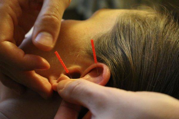 Auricular acupuncture