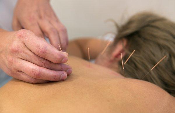 Acupuncture for upper back pain and chest congestion