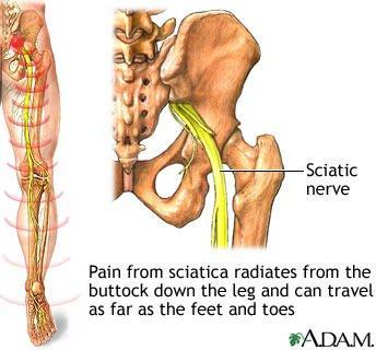 Advanced Spinal Rehabilitation has designed the ultimate Non-Surgical Sciatica treatment and rehabilitation program!