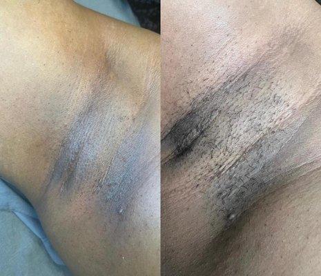 Before and after for an underarm wax.