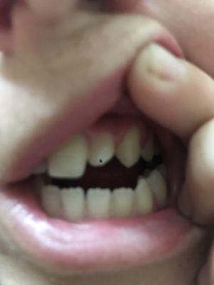 Root canal to front tooth