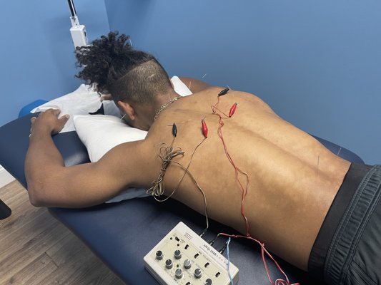 Acupuncture with electrical stimulation to the medial, trapezius muscles and trapezium muscles of both shoulders