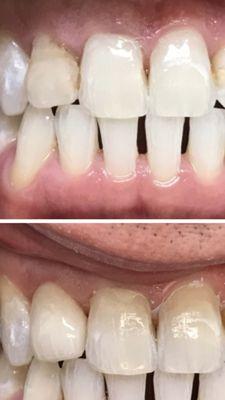 Lateral crown with characterization